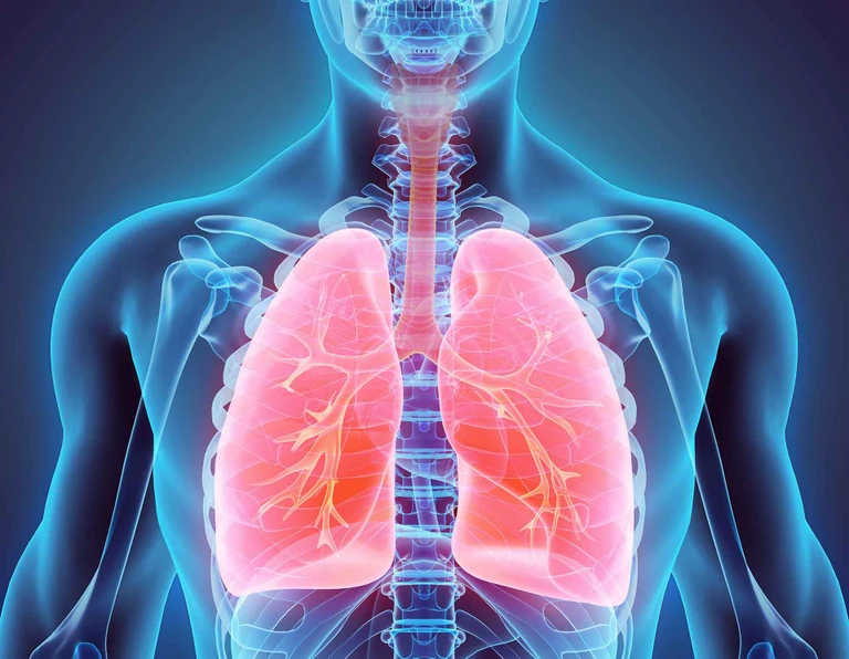 Exploring biological characteristics  of lung cancer in each patient gives clues on differences in the way the patient’s immune system fights against the tumour